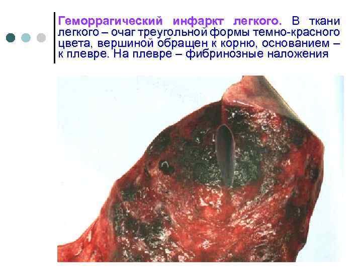 Геморрагический инфаркт легкого. В ткани легкого – очаг треугольной формы темно-красного цвета, вершиной обращен