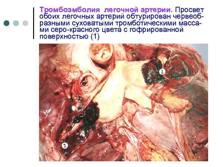 Тромбоэмболия легочной артерии. Просвет обоих легочных артерий обтурирован червеобразными суховатыми тромботическими массами серо-красного цвета