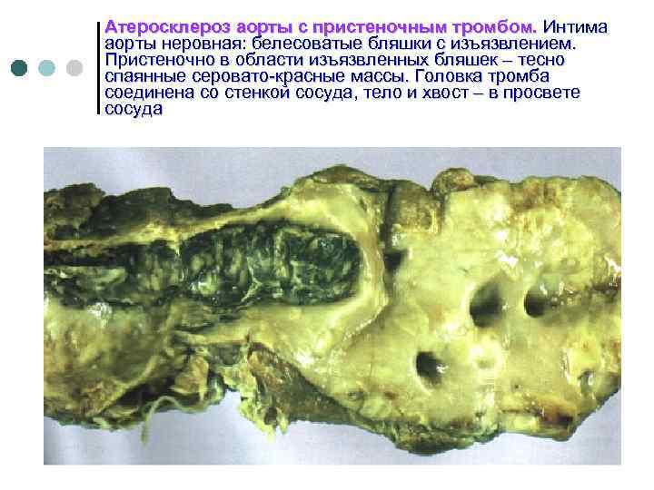 Атеросклероз аорты с пристеночным тромбом. Интима аорты неровная: белесоватые бляшки с изъязвлением. Пристеночно в