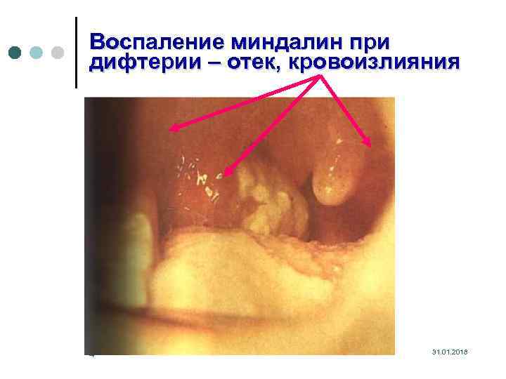 Воспаление миндалин при дифтерии – отек, кровоизлияния 4 31. 01. 2018 