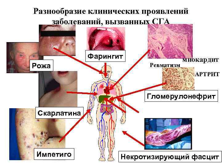 Разнообразие клинических проявлений заболеваний, вызванных СГА Фарингит Рожа Ревматизм миокардит АРТРИТ Гломерулонефрит Скарлатина Импетиго