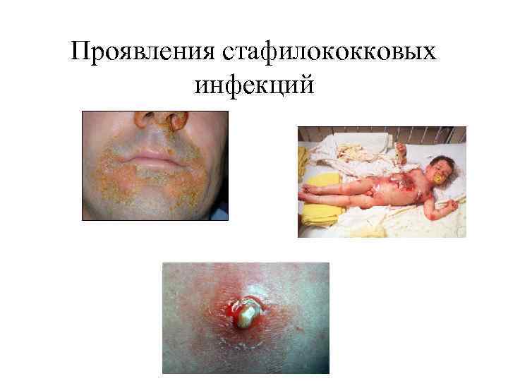 Проявления стафилококковых инфекций 