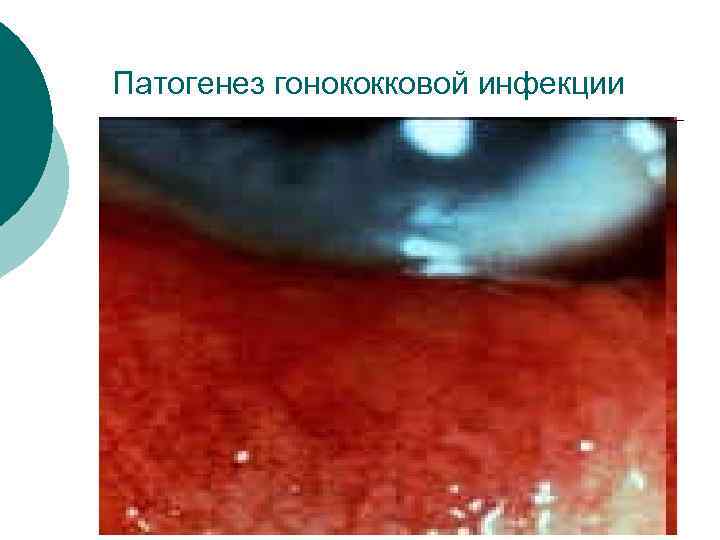 Патогенез гонококковой инфекции 