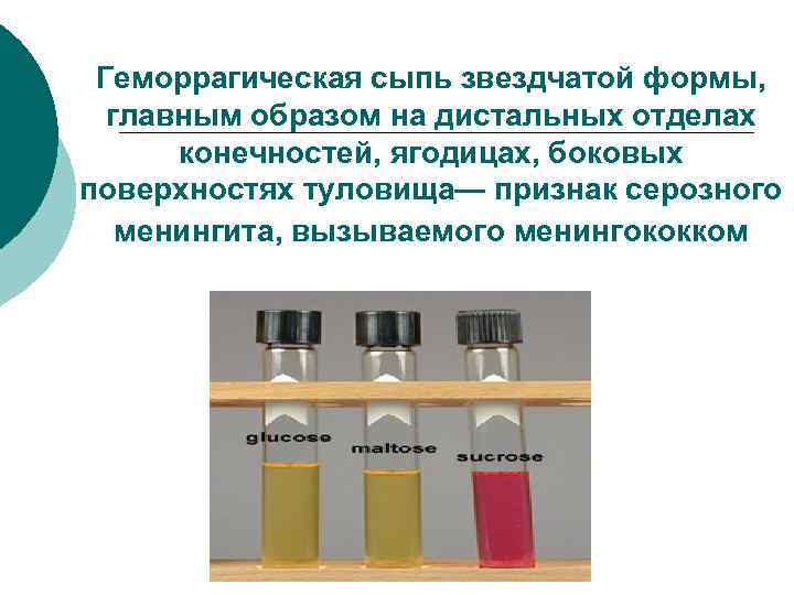 Геморрагическая сыпь звездчатой формы, главным образом на дистальных отделах конечностей, ягодицах, боковых поверхностях туловища—