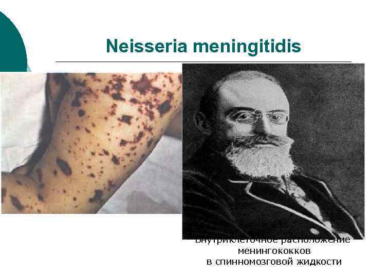 Neisseria meningitidis Внутриклеточное расположение менингококков в спинномозговой жидкости 