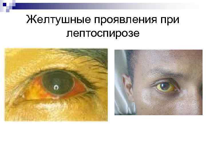 Желтушные проявления при лептоспирозе 