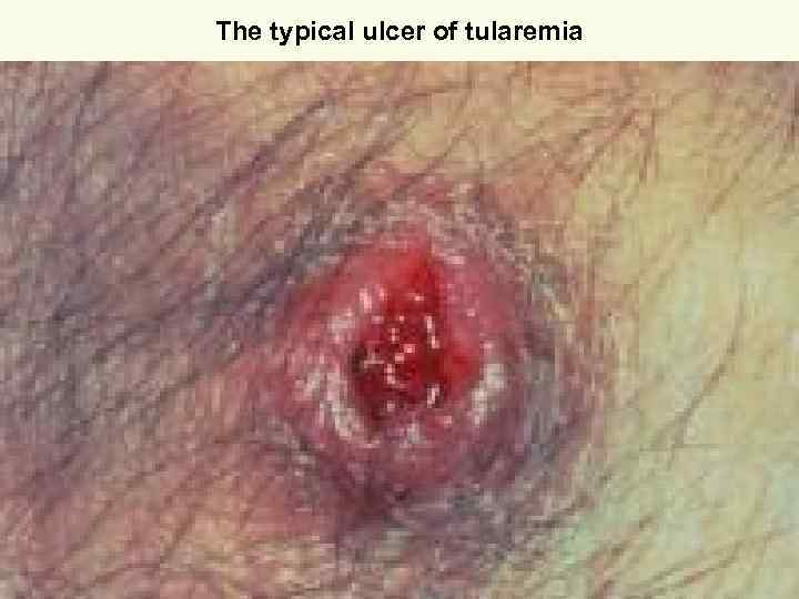 The typical ulcer of tularemia 