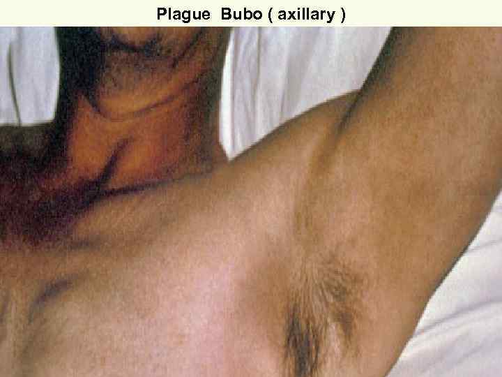 Plague Bubo ( axillary ) 