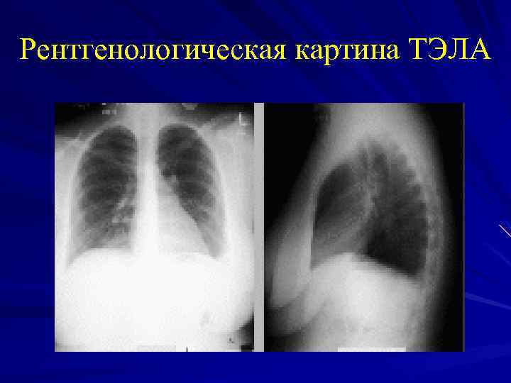 Рентгенологическая картина ТЭЛА 