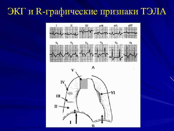 ЭКГ и R-графические признаки ТЭЛА 