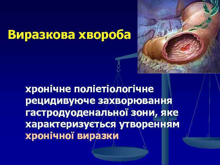 Виразкова хвороба хронічне поліетіологічне рецидивуюче захворювання гастродуоденальної зони, яке характеризується утворенням хронічної виразки 