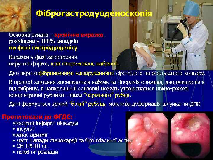 Фіброгастродуоденоскопія Основна ознака – хронічна виразка, розміщена у 100% випадків на фоні гастродуоденіту Виразки