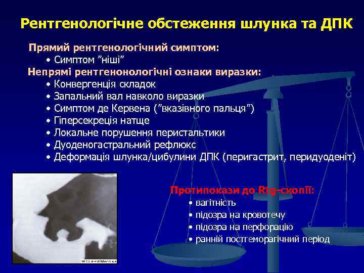 Рентгенологічне обстеження шлунка та ДПК Прямий рентгенологічний симптом: • Симптом ”ніші” Непрямі рентгенонологічні ознаки