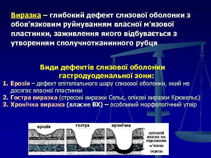 Виразка – глибокий дефект слизової оболонки з обов’язковим руйнуванням власної м'язової пластинки, заживлення якого
