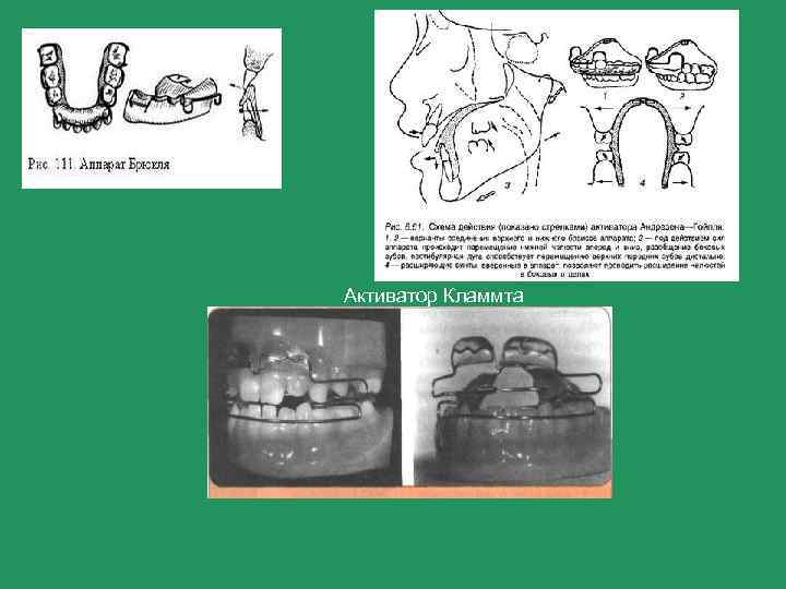 Аппарат кламмта ортодонтия фото