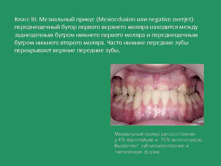 Мезиальная окклюзия презентация ортодонтия