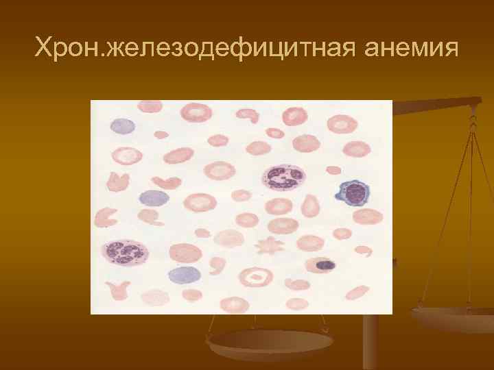 Хрон. железодефицитная анемия 