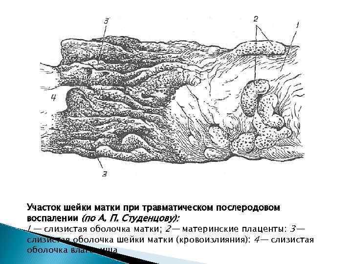 Участок шейки матки при травматическом послеродовом воспалении (по А. П. Студенцову): I — слизистая