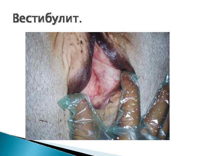 Вестибулит. 