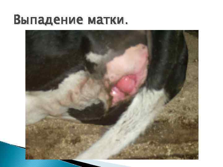 Выпадение матки 3 степени фото