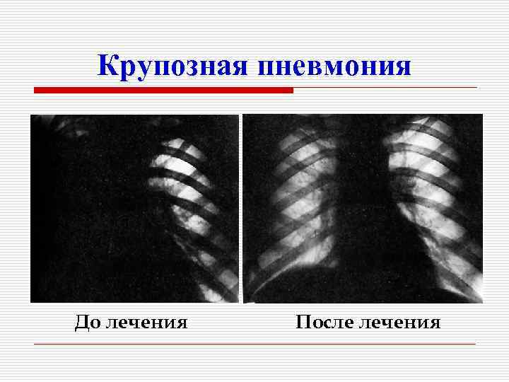 Крупозная пневмония До лечения После лечения 