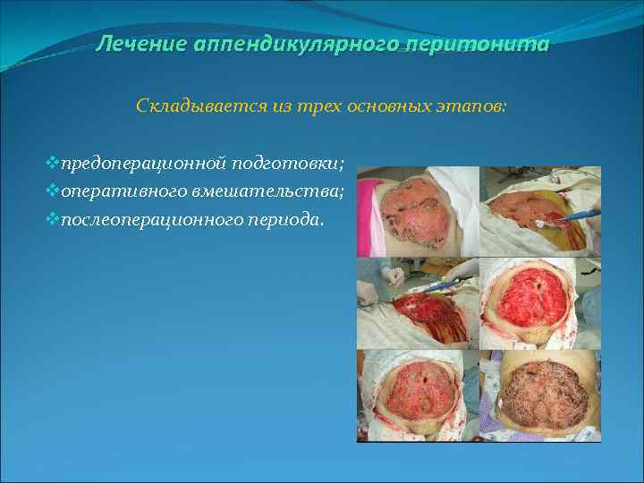 Лечение аппендикулярного перитонита Складывается из трех основных этапов: vпредоперационной подготовки; vоперативного вмешательства; vпослеоперационного периода.