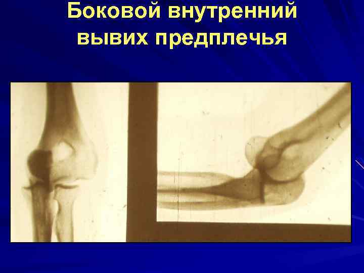 Боковой внутренний вывих предплечья 