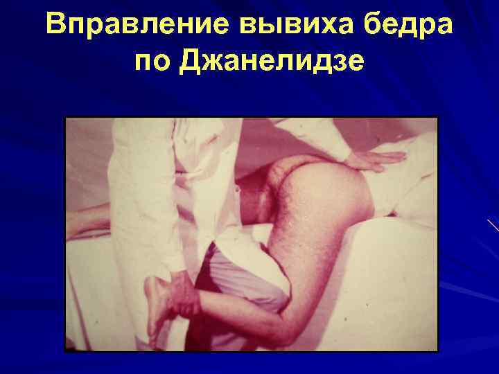 Вправление вывиха бедра по Джанелидзе 