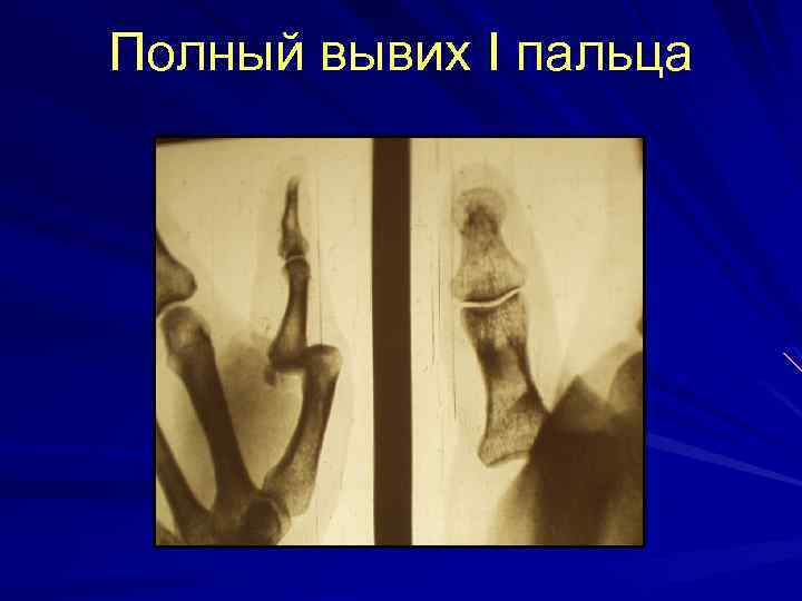 Полный вывих I пальца 