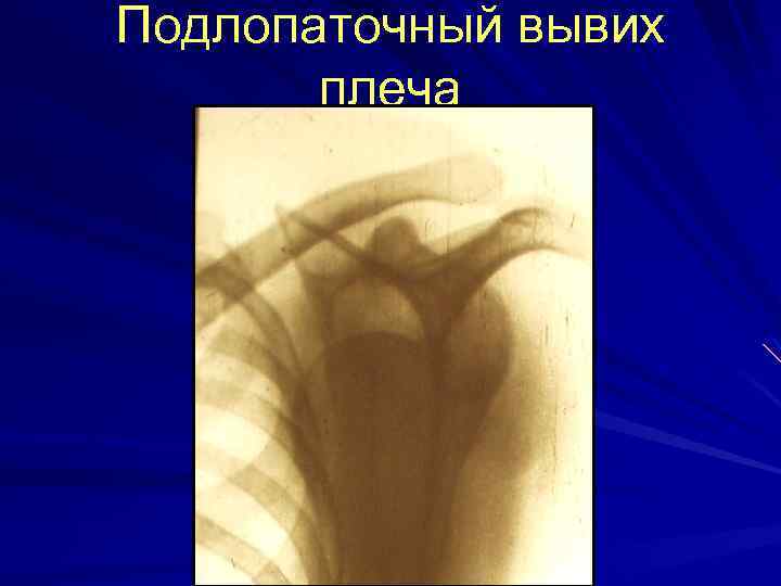 Подлопаточный вывих плеча 