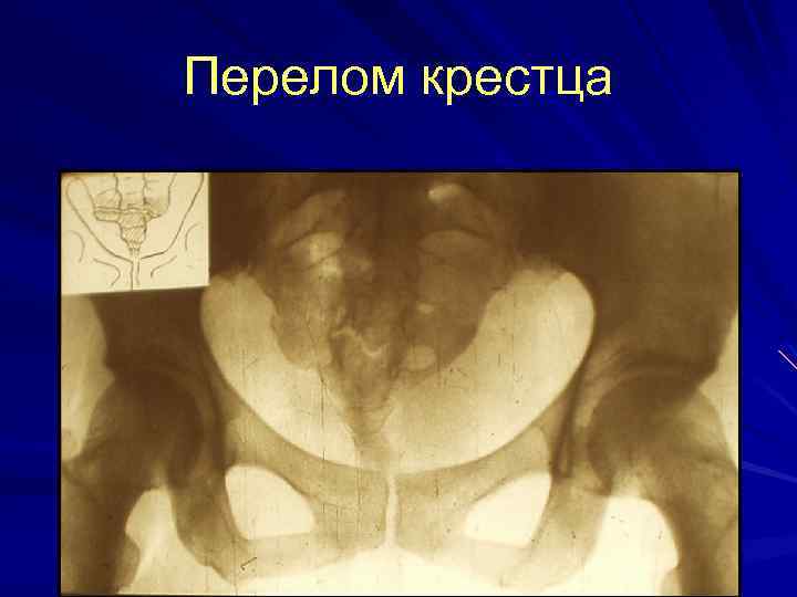 Перелом крестца 