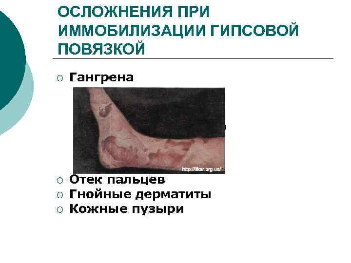 ОСЛОЖНЕНИЯ ПРИ ИММОБИЛИЗАЦИИ ГИПСОВОЙ ПОВЯЗКОЙ ¡ Гангрена Гнойные дерматиты ¡ ¡ ¡ Отек пальцев