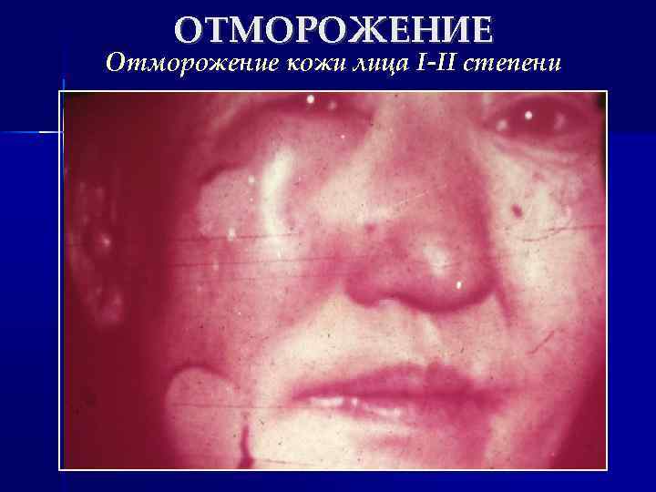 ОТМОРОЖЕНИЕ Отморожение кожи лица I-II степени 
