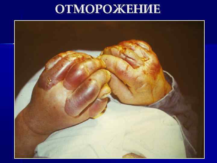 ОТМОРОЖЕНИЕ 