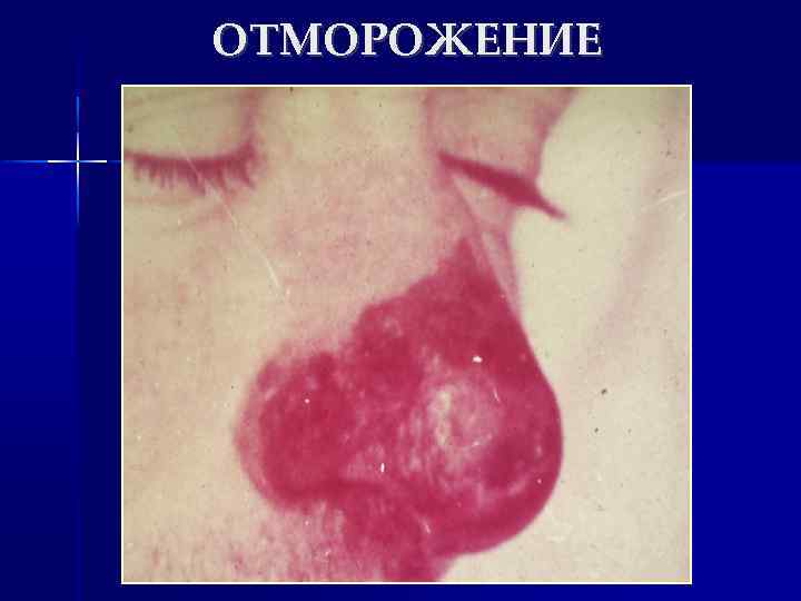 ОТМОРОЖЕНИЕ 