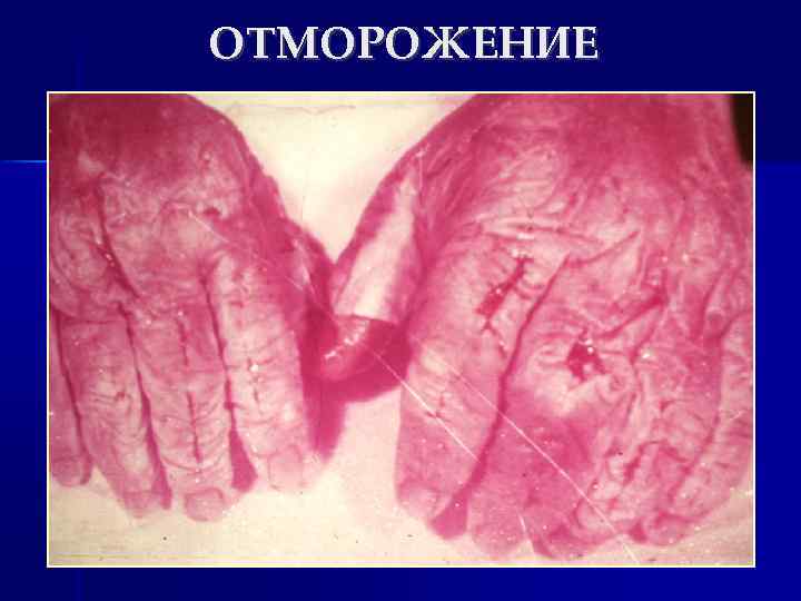 ОТМОРОЖЕНИЕ 