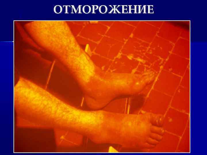 ОТМОРОЖЕНИЕ 