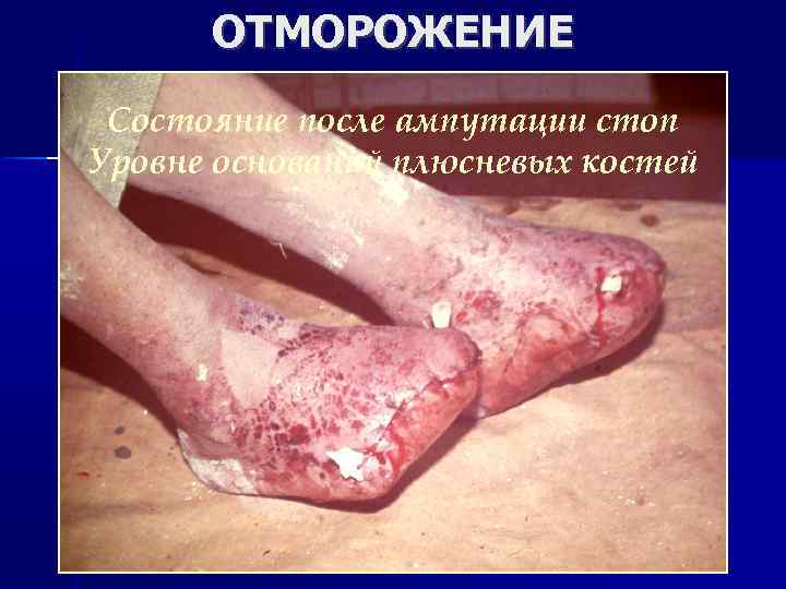 ОТМОРОЖЕНИЕ Состояние после ампутации стоп Уровне оснований плюсневых костей 