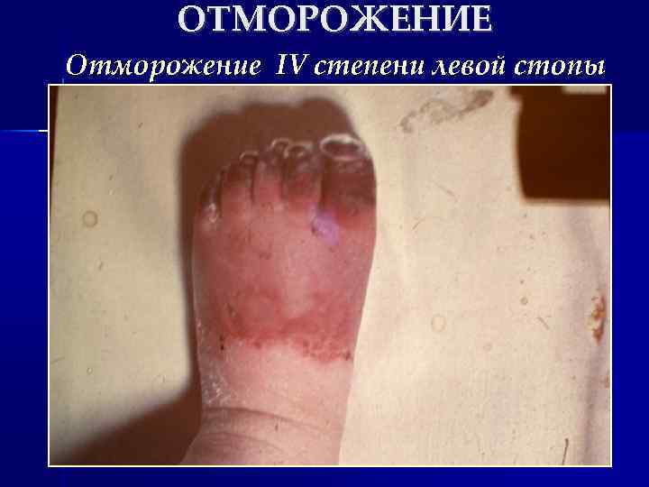 ОТМОРОЖЕНИЕ Отморожение IV степени левой стопы 