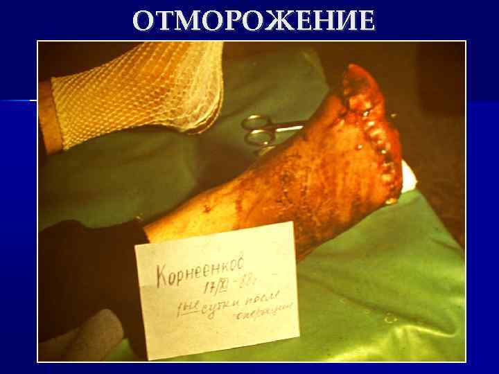 ОТМОРОЖЕНИЕ 