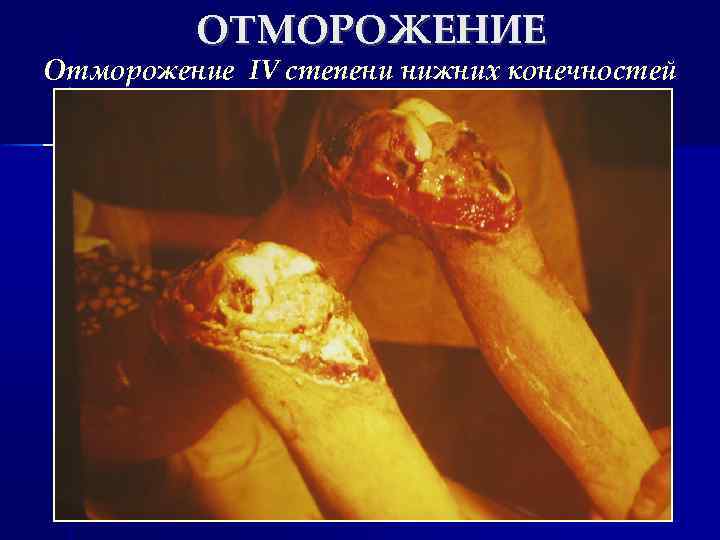 ОТМОРОЖЕНИЕ Отморожение IV степени нижних конечностей 