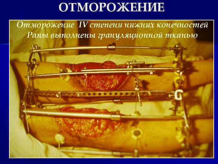 ОТМОРОЖЕНИЕ Отморожение IV степени нижних конечностей Раны выполнены грануляционной тканью 