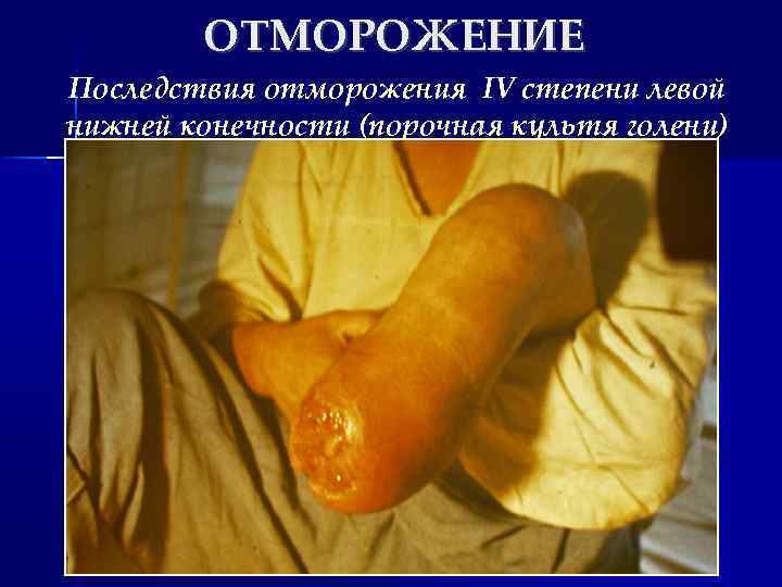 ОТМОРОЖЕНИЕ Последствия отморожения IV степени левой нижней конечности (порочная культя голени) 