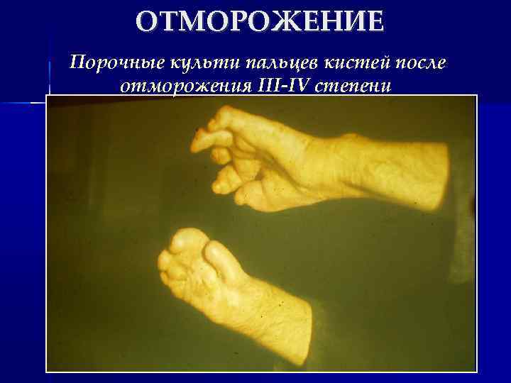 ОТМОРОЖЕНИЕ Порочные культи пальцев кистей после отморожения III-IV степени 