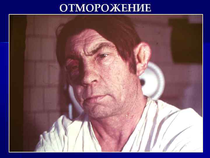 ОТМОРОЖЕНИЕ 