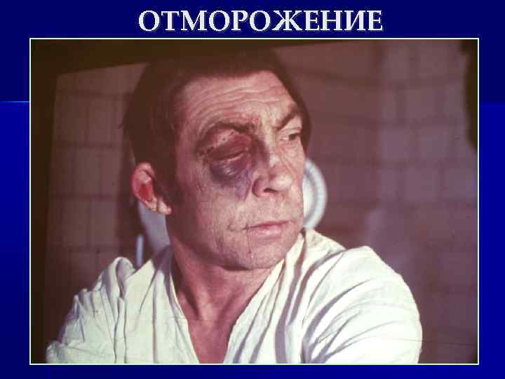 ОТМОРОЖЕНИЕ 