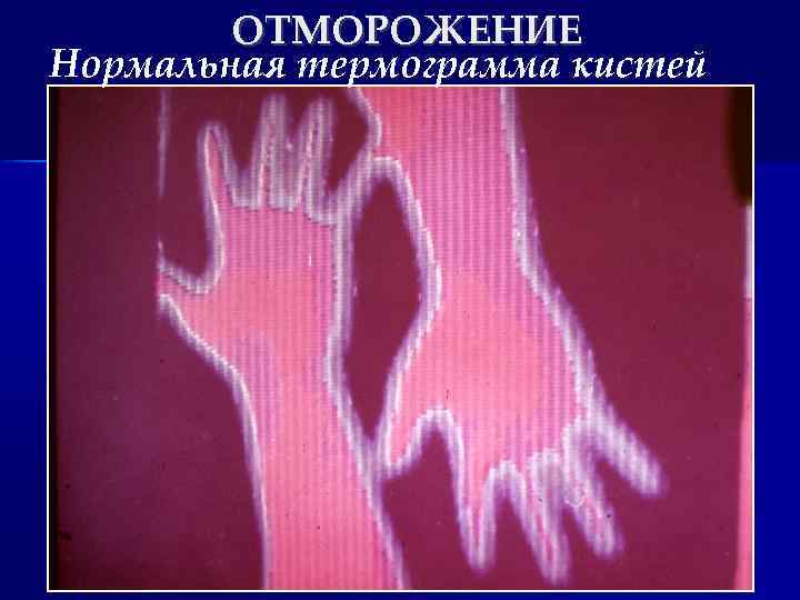 ОТМОРОЖЕНИЕ Нормальная термограмма кистей 