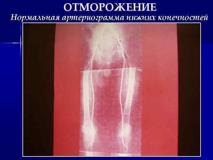 ОТМОРОЖЕНИЕ Нормальная артериограмма нижних конечностей 