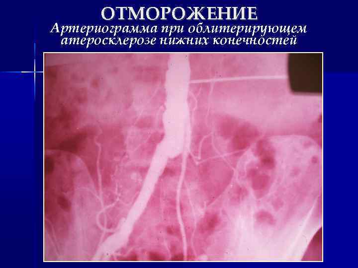 ОТМОРОЖЕНИЕ Артериограмма при облитерирующем атеросклерозе нижних конечностей 