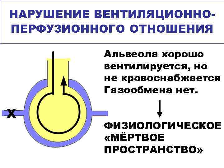 НАРУШЕНИЕ ВЕНТИЛЯЦИОННОПЕРФУЗИОННОГО ОТНОШЕНИЯ Альвеола хорошо вентилируется, но не кровоснабжается Газообмена нет. Х ФИЗИОЛОГИЧЕСКОЕ «МЁРТВОЕ